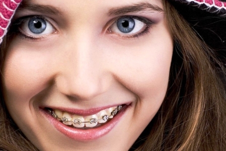 Behel, Ini Makanan yang Harus Dihindari Para Pemakainya